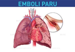 Obat Emboli Paru