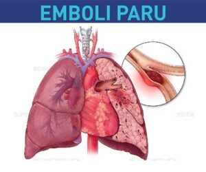 Obat Emboli Paru