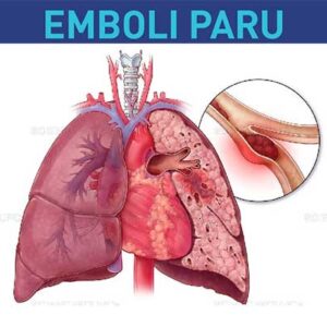 Obat Emboli Paru