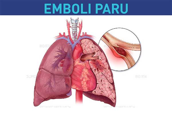 Obat Emboli Paru